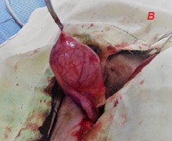 Left testicle removed from the inguinal region